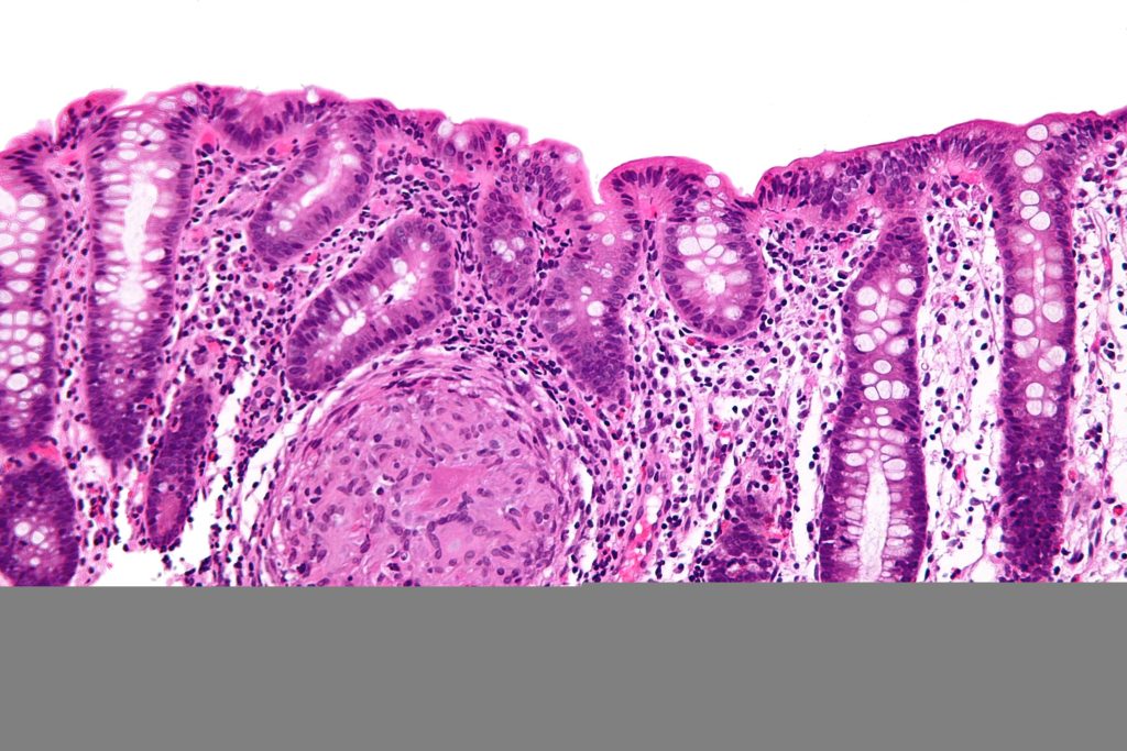 Cos'è il Morbo di Crohn, sintomi e cause
