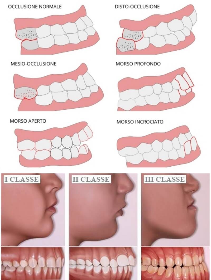 Malocclusione Dentale e mandibola storta: conseguenze e rimedi