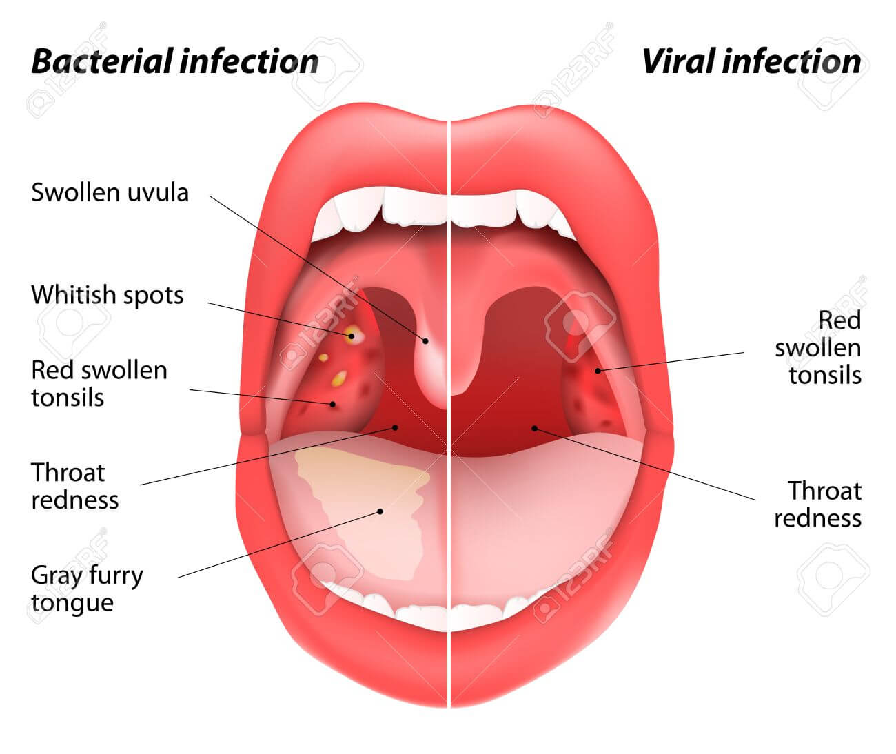 stomatite-e-infiammazione-sulla-lingua-e-bocca-sintomi-e-rimedi